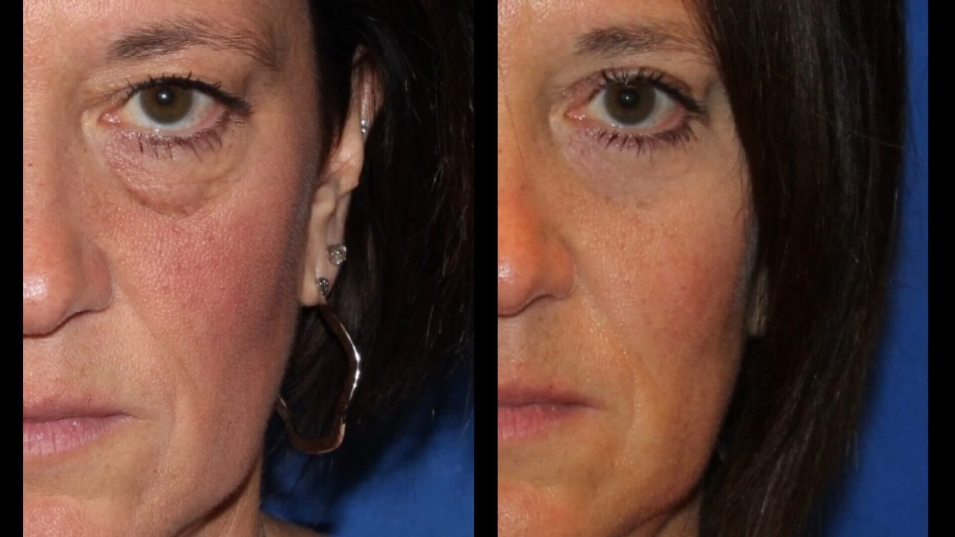 Blepharoplasty in East Syracuse NY Natural Face Clinic