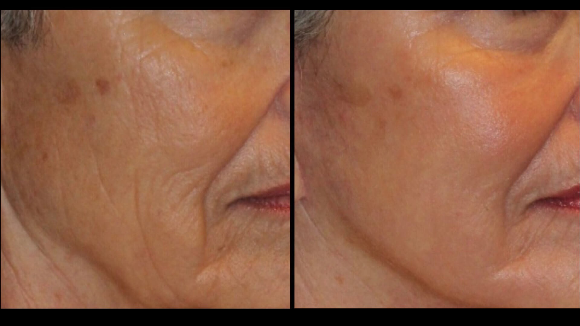 Laser Skin Resurfacing in East Syracuse NY Natural Face Clinic